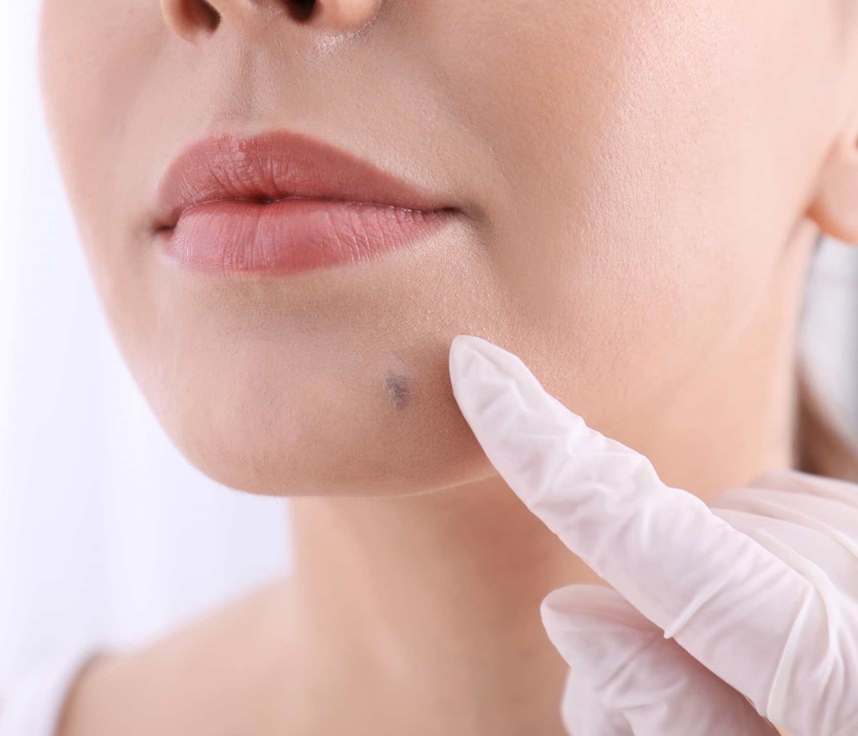 Tumeur sur le visage : les traitements réparateurs | Genève | Face Clinic
